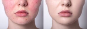 Young woman with rosacea has flushed, red skin before IPL, and after treatment her skin is clear and bright
